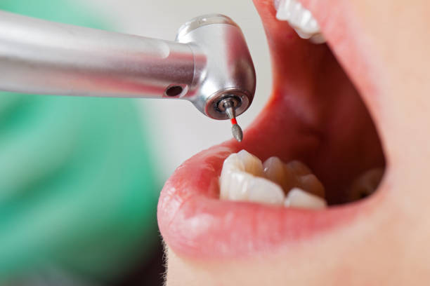 Best Chipped Tooth Repair Near Me  in Merrydale, LA